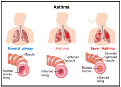 Asthma img