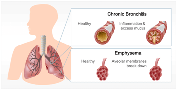 COPD