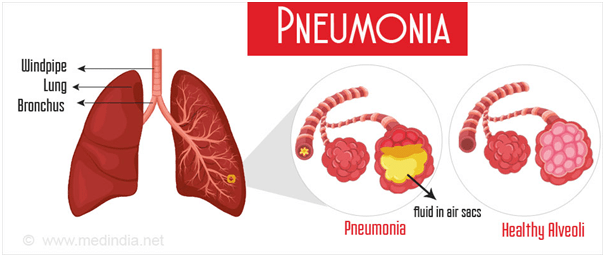 pneumonia