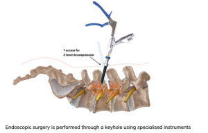 Endoscopic surgery