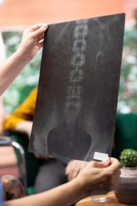 spine-surgery-in-vadodara-welcare-hospital